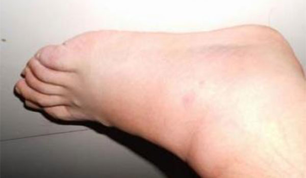 ����Ť��������ô�� ����Ť����ȷ��������